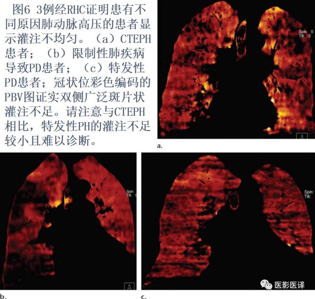 肺动脉高压的双能CT影像：挑战与机遇