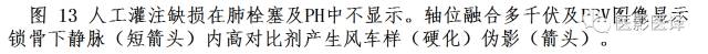 肺动脉高压的双能CT影像：挑战与机遇