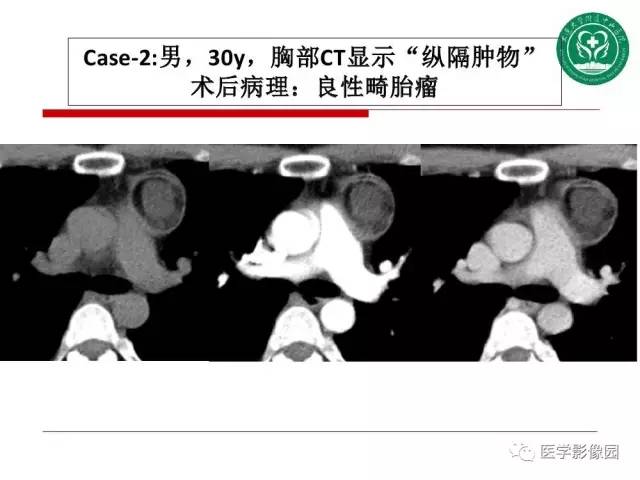 【PPT】纵隔肿瘤的影像检查规范及诊断思路
