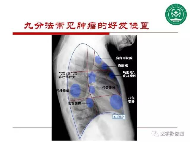 【PPT】纵隔肿瘤的影像检查规范及诊断思路