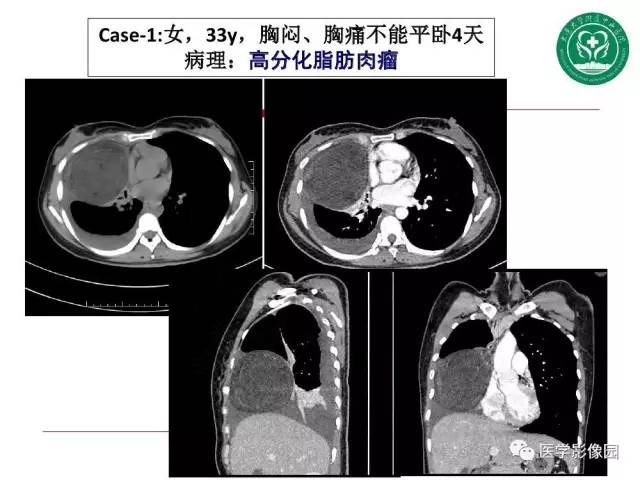 【PPT】纵隔肿瘤的影像检查规范及诊断思路