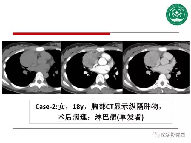 【PPT】纵隔肿瘤的影像检查规范及诊断思路