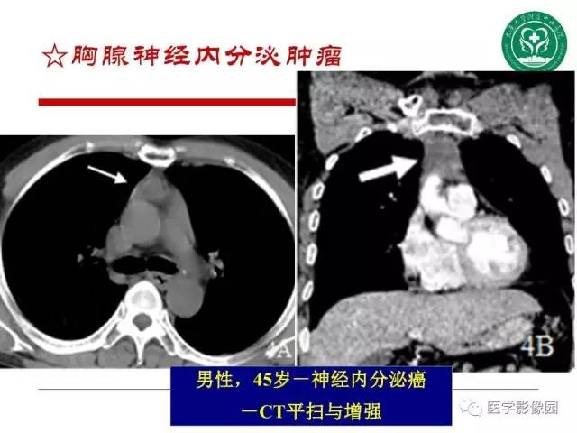 【PPT】纵隔肿瘤的影像检查规范及诊断思路