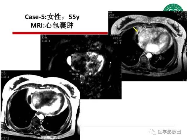 【PPT】纵隔肿瘤的影像检查规范及诊断思路
