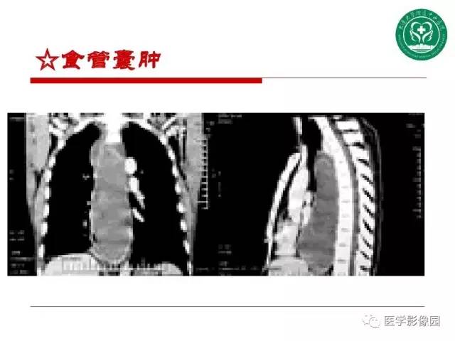 【PPT】纵隔肿瘤的影像检查规范及诊断思路
