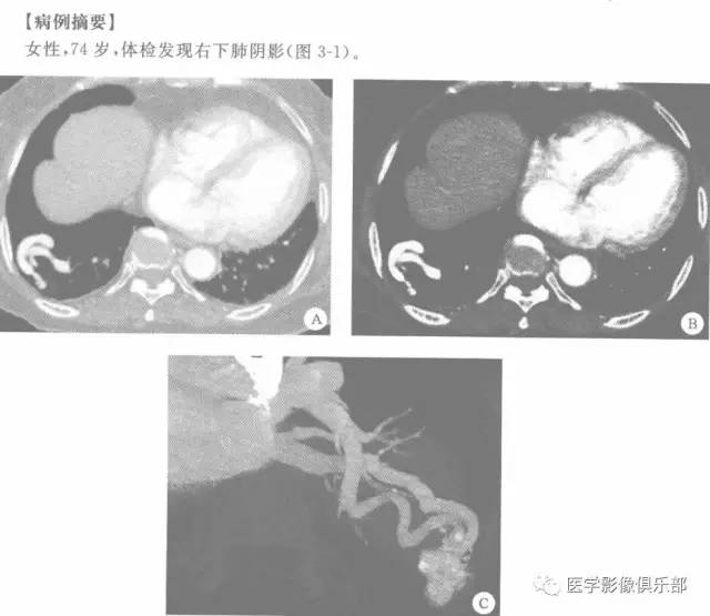 【病例】肺动静脉畸形1例CT影像表现