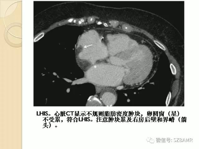 【PPT】心脏肿块CT诊断