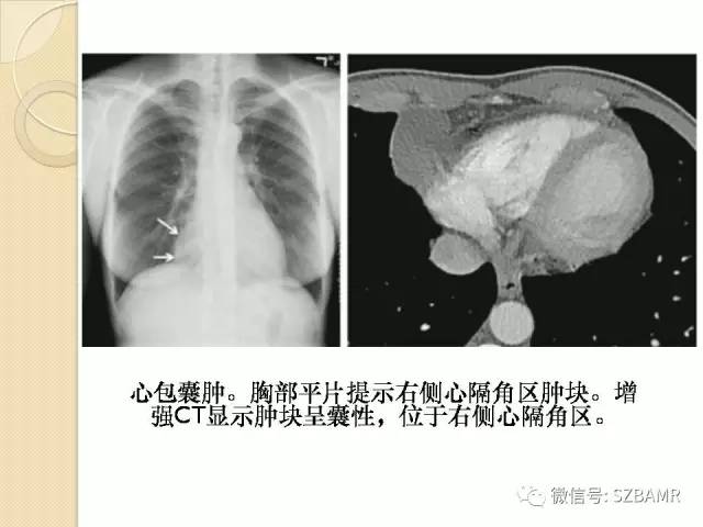 【PPT】心脏肿块CT诊断