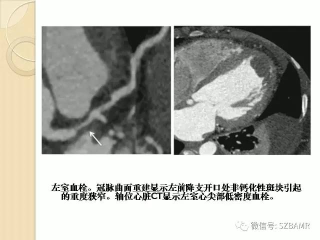 【PPT】心脏肿块CT诊断