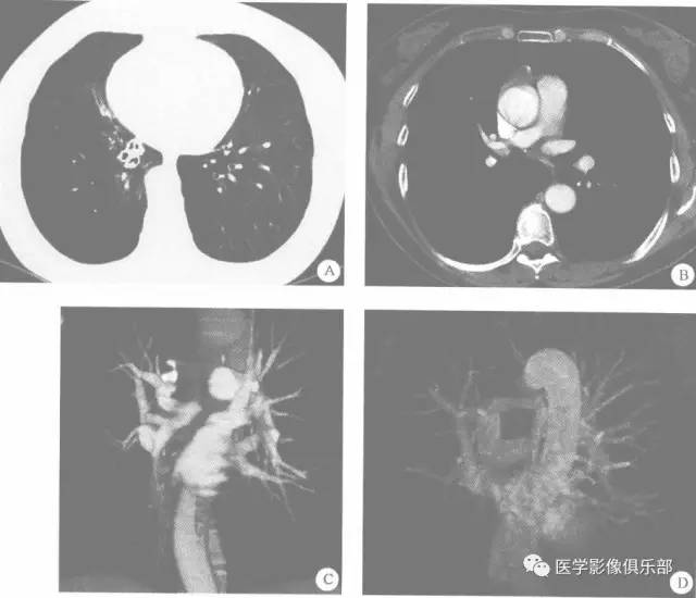 【病例】右下肺动脉发育不良1例CT影像表现