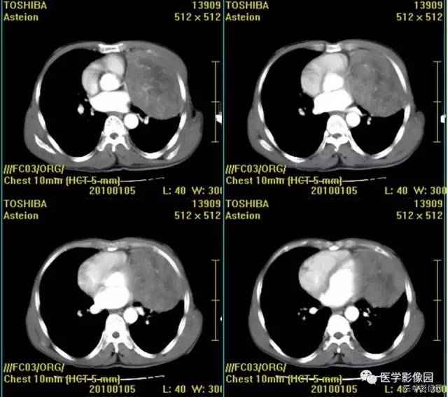 【病例】胸腺类癌1例CT影像表现