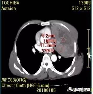 【病例】胸腺类癌1例CT影像表现