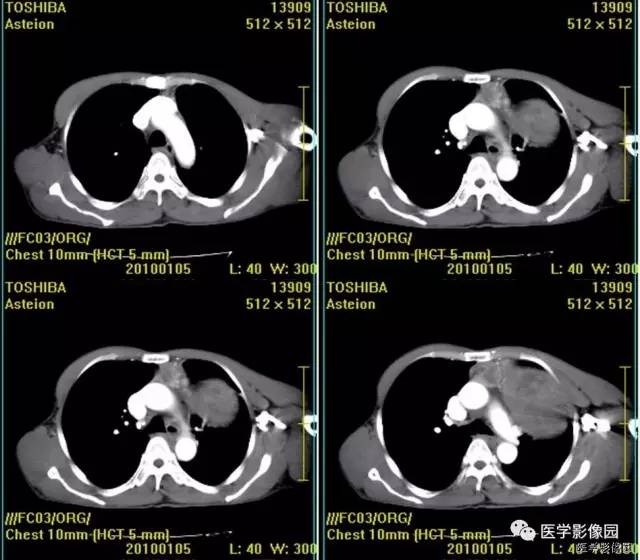 【病例】胸腺类癌1例CT影像表现