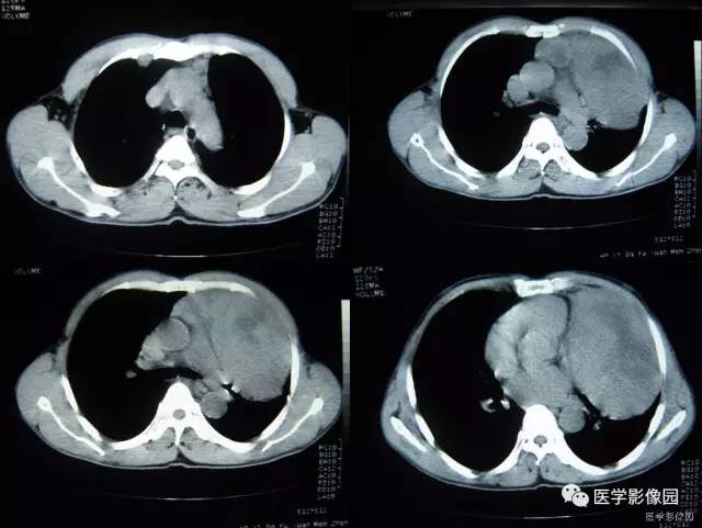 【病例】胸腺类癌1例CT影像表现
