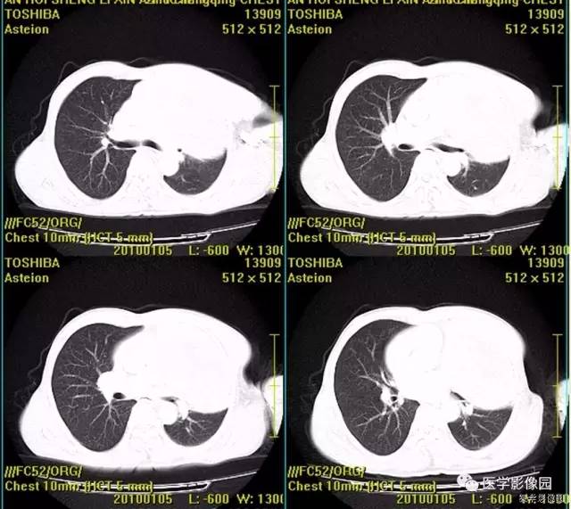 【病例】胸腺类癌1例CT影像表现