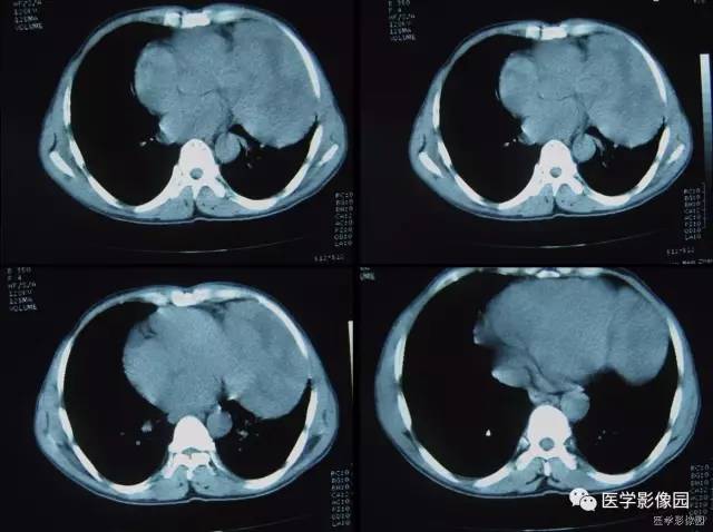 【病例】胸腺类癌1例CT影像表现