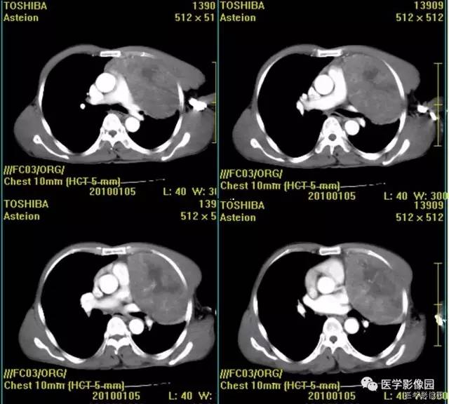 【病例】胸腺类癌1例CT影像表现