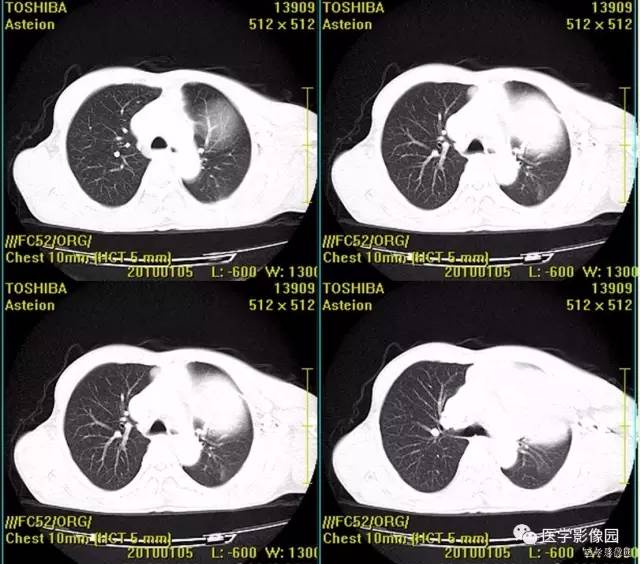 【病例】胸腺类癌1例CT影像表现
