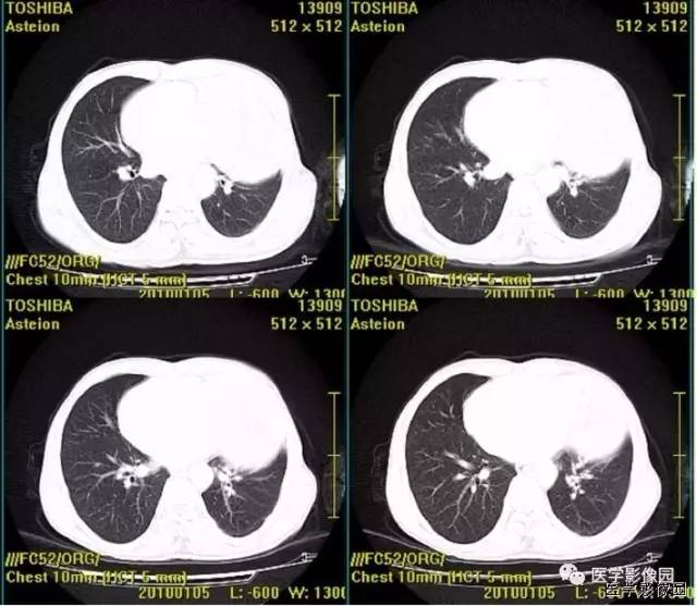 【病例】胸腺类癌1例CT影像表现