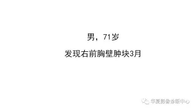 【病例】胸壁软骨肉瘤1例CT影像表现