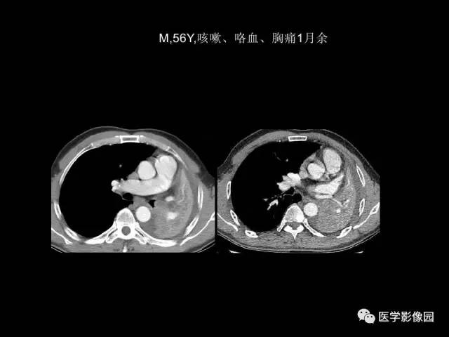 【PPT】肺结节MRI检查技术及诊断思路