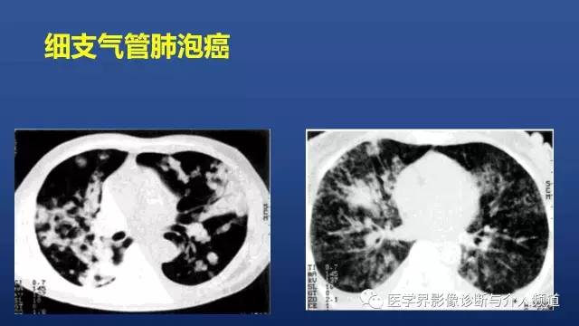 【PPT】胸部疾病鉴别诊断精要