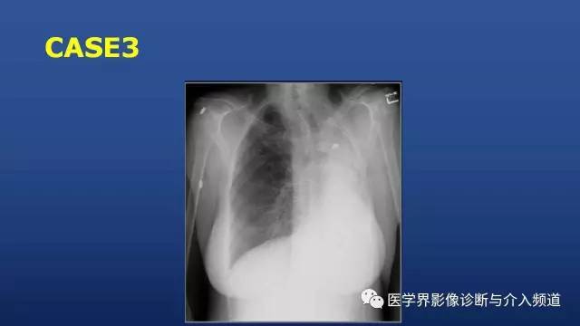 【PPT】胸部疾病鉴别诊断精要