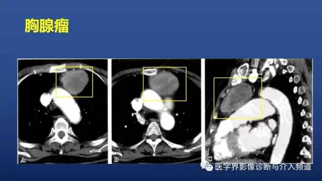 【PPT】胸部疾病鉴别诊断精要