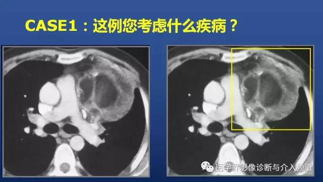 【PPT】胸部疾病鉴别诊断精要