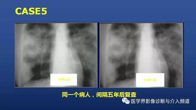 【PPT】胸部疾病鉴别诊断精要