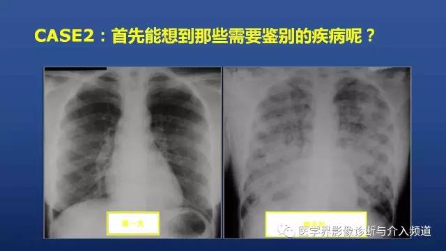 【PPT】胸部疾病鉴别诊断精要