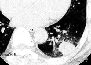 【病例】肺炎性肌纤维母细胞瘤1例CT影像表现