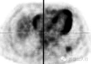 【病例】肺炎性肌纤维母细胞瘤1例CT影像表现 【病例】肺炎性肌纤维母细胞瘤1例CT影像表现