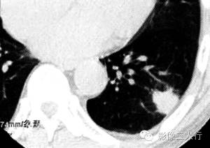 【病例】肺炎性肌纤维母细胞瘤1例CT影像表现 【病例】肺炎性肌纤维母细胞瘤1例CT影像表现