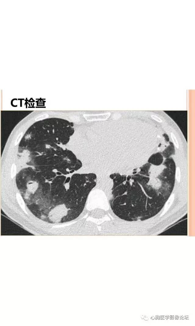 【病例】肺淋巴瘤样肉芽肿LYG一例CT影像诊断与鉴别