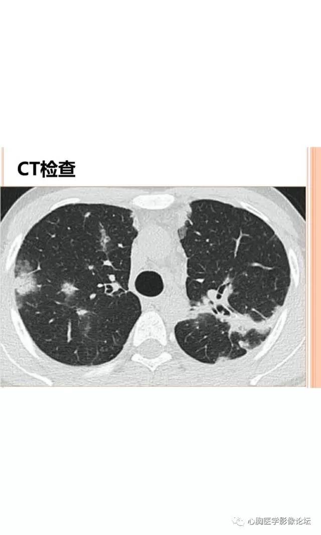 【病例】肺淋巴瘤样肉芽肿LYG一例CT影像诊断与鉴别