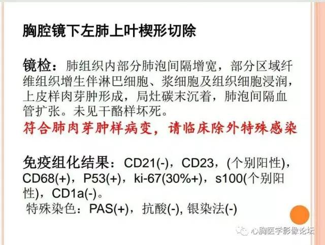 【病例】肺淋巴瘤样肉芽肿LYG一例CT影像诊断与鉴别