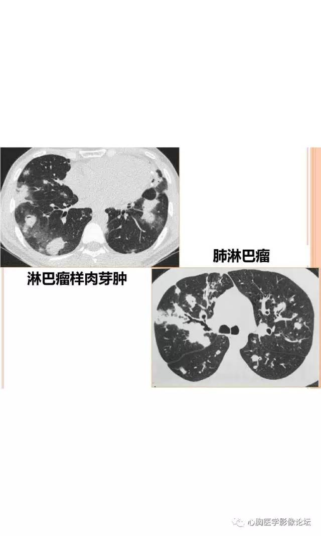 【病例】肺淋巴瘤样肉芽肿LYG一例CT影像诊断与鉴别