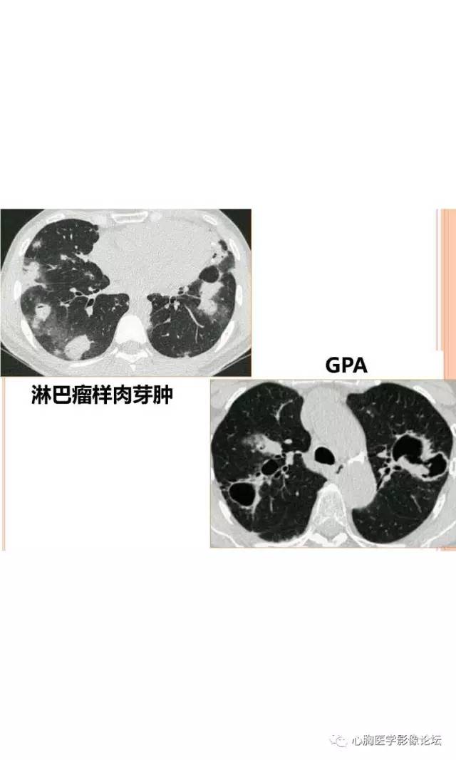 【病例】肺淋巴瘤样肉芽肿LYG一例CT影像诊断与鉴别