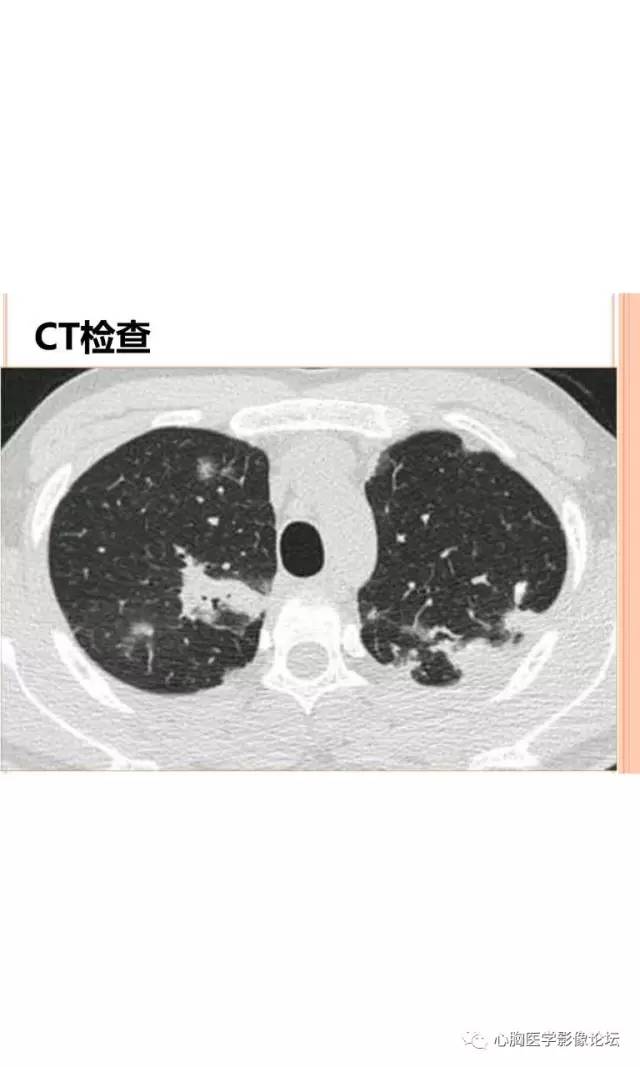 【病例】肺淋巴瘤样肉芽肿LYG一例CT影像诊断与鉴别