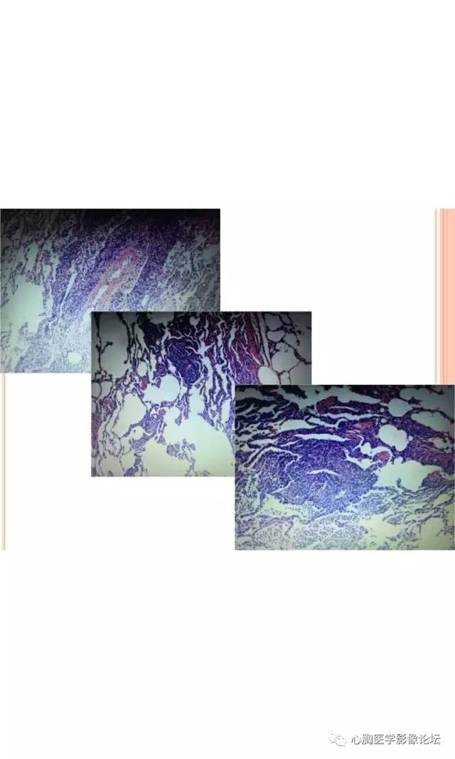 【病例】肺淋巴瘤样肉芽肿LYG一例CT影像诊断与鉴别