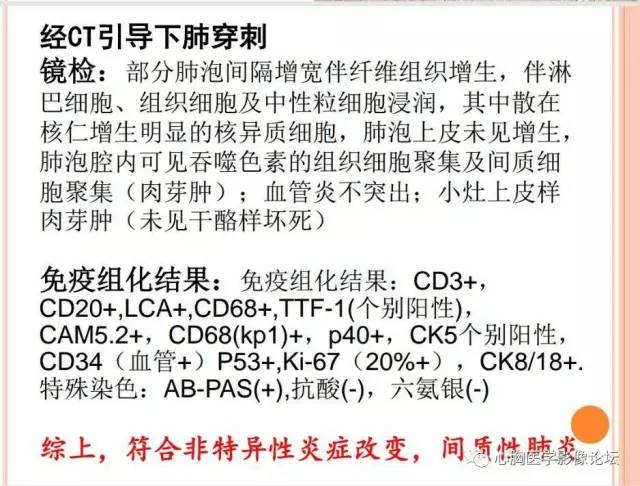 【病例】肺淋巴瘤样肉芽肿LYG一例CT影像诊断与鉴别