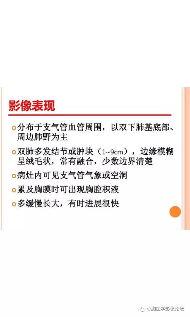 【病例】肺淋巴瘤样肉芽肿LYG一例CT影像诊断与鉴别
