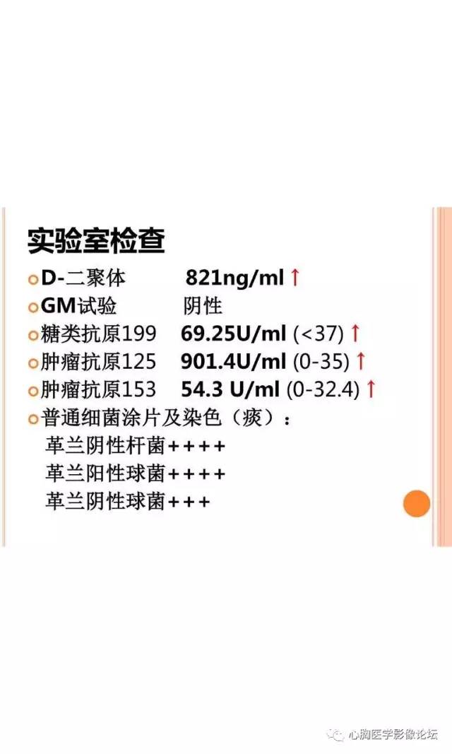 【病例】肺淋巴瘤样肉芽肿LYG一例CT影像诊断与鉴别