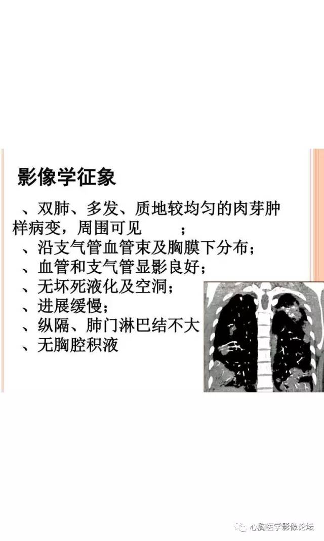 【病例】肺淋巴瘤样肉芽肿LYG一例CT影像诊断与鉴别