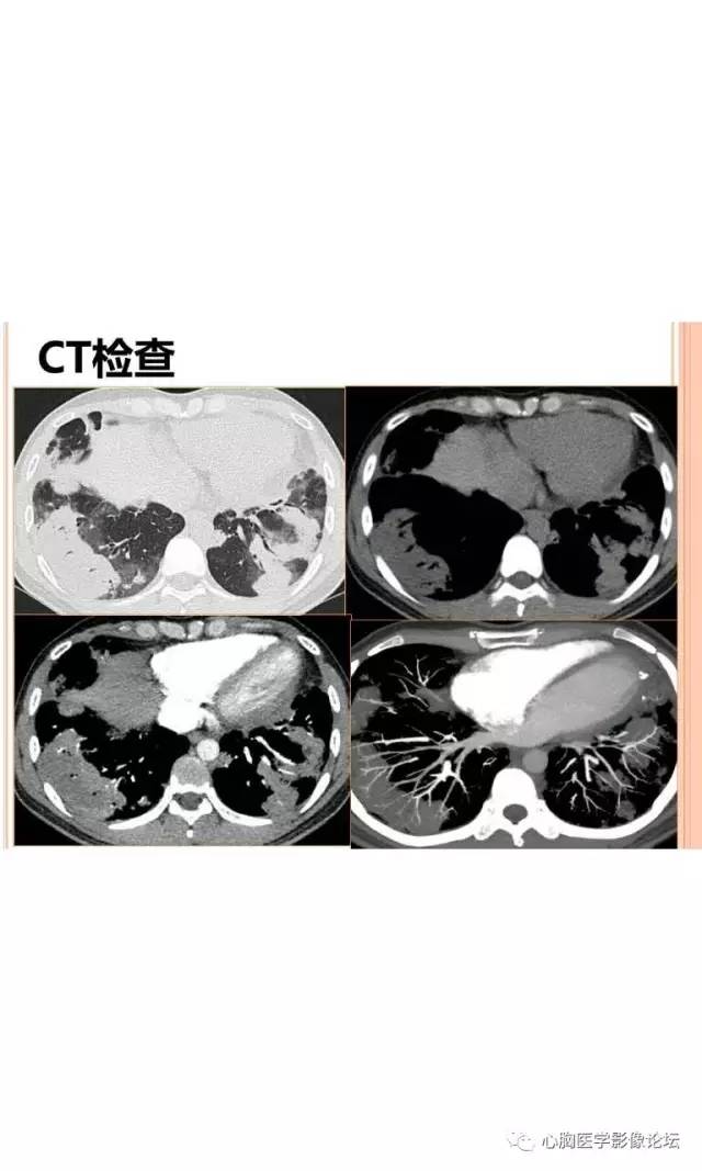 【病例】肺淋巴瘤样肉芽肿LYG一例CT影像诊断与鉴别