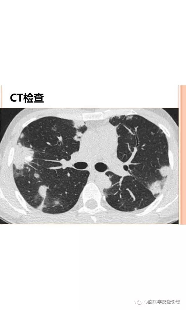 【病例】肺淋巴瘤样肉芽肿LYG一例CT影像诊断与鉴别