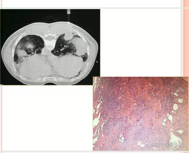 【病例】肺淋巴瘤样肉芽肿LYG一例CT影像诊断与鉴别