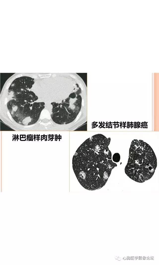 【病例】肺淋巴瘤样肉芽肿LYG一例CT影像诊断与鉴别