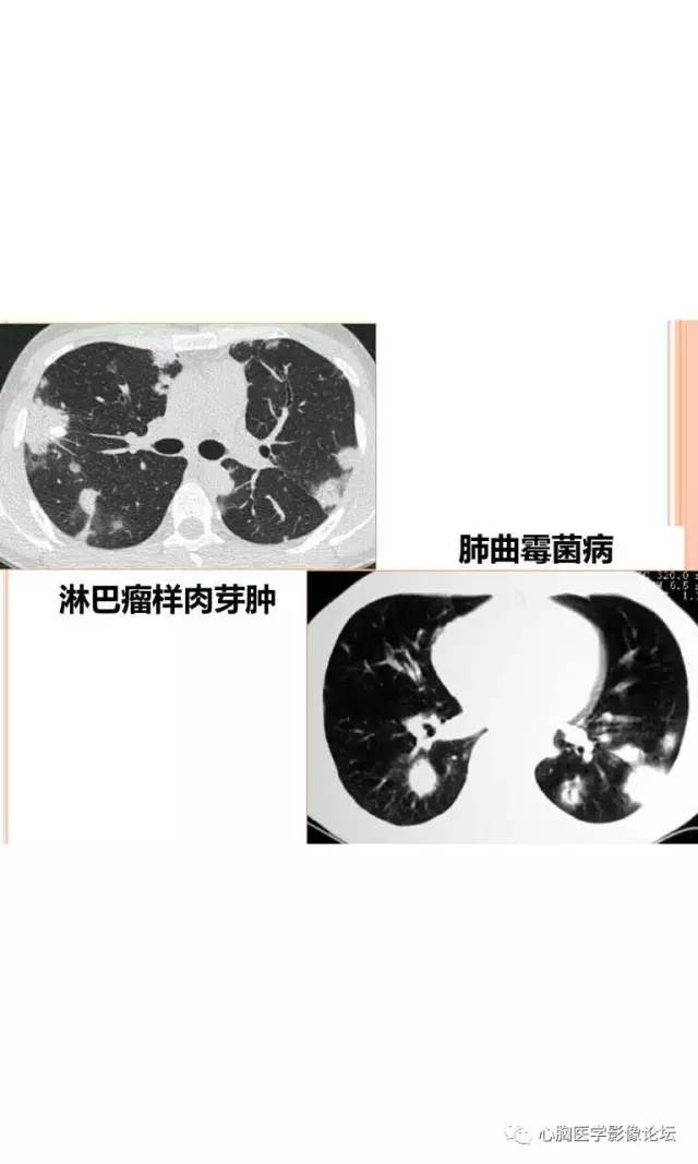 【病例】肺淋巴瘤样肉芽肿LYG一例CT影像诊断与鉴别